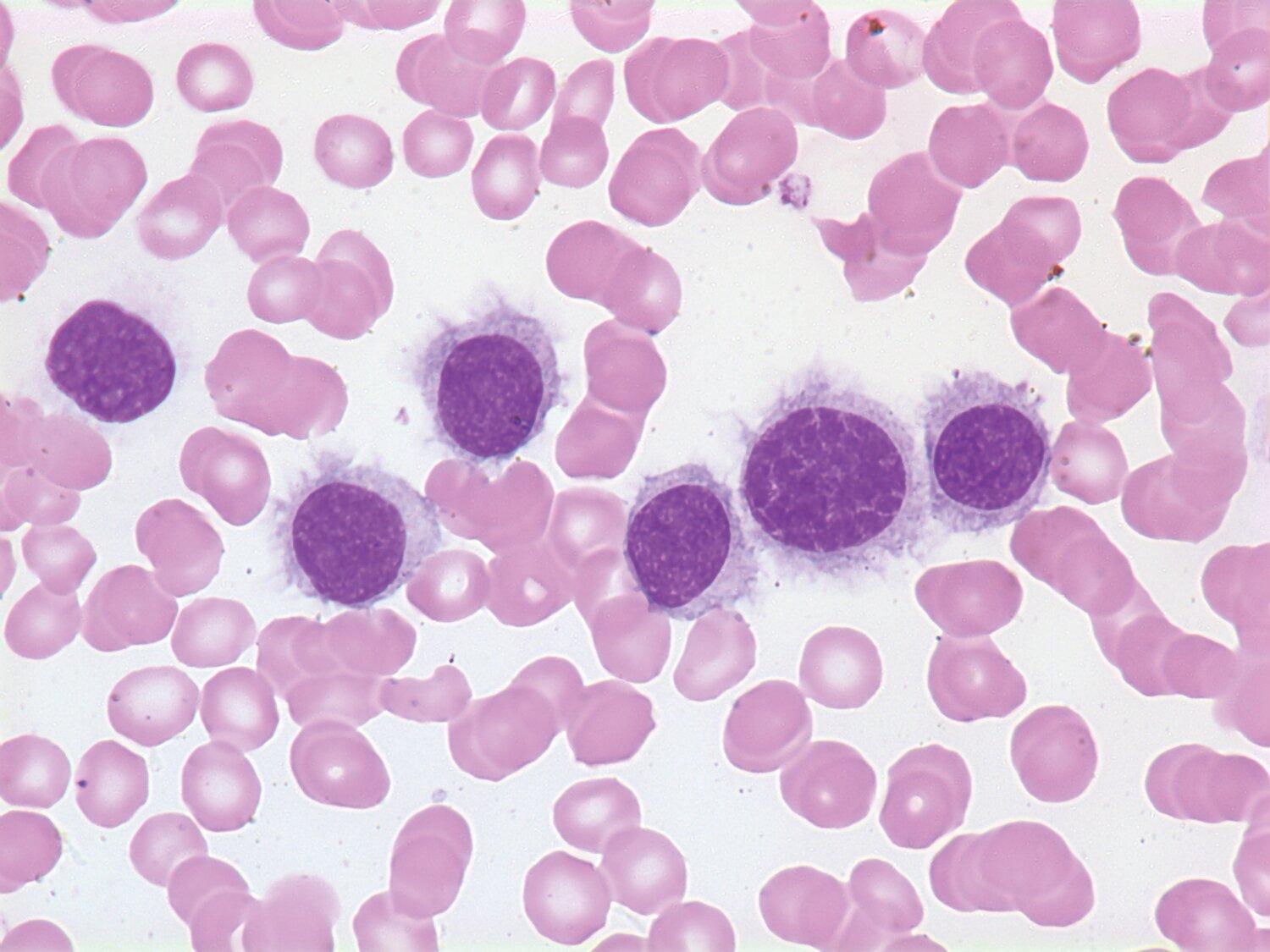 Understanding Hairy Cell Leukemia (HCL): Symptoms, Diagnosis, and Treatment  Introduction to HCL  Hairy Cell Leukemia (HCL) is a relatively rare form of cancer that affects the blood and bone marrow. It is classified as a type of chronic lymphoproliferative disorder, specifically a subtype of B-cell chronic lymphocytic leukemia (CLL). HCL gets its name from the abnormal appearance of the leukemic cells under a microscope, which feature fine, hair-like projections on their surface.  Symptoms of HCL  The symptoms of Hairy Cell Leukemia are often insidious and may develop slowly over time. Some common symptoms include:  Fatigue and weakness Unexplained weight loss Recurrent infections Enlarged spleen and/or liver Easy bruising or bleeding Abdominal discomfort or fullness It's important to note that not all individuals with HCL will experience the same symptoms, and some may remain asymptomatic for a prolonged period.  Diagnosing HCL  Diagnosing Hairy Cell Leukemia typically involves a series of tests and evaluations. These may include:  Blood tests: A complete blood count (CBC) is conducted to assess the number and appearance of different blood cells. HCL is characterized by the presence of abnormal B lymphocytes with hair-like projections.  Bone marrow biopsy: A small sample of bone marrow is extracted and examined under a microscope to confirm the presence of HCL cells.  Immunophenotyping: This test helps determine the specific subtype of leukemia by analyzing the surface markers expressed by the abnormal cells.  Imaging tests: X-rays, ultrasounds, or computed tomography (CT) scans may be performed to evaluate the size of the spleen and liver, as well as to check for any enlarged lymph nodes.  Treatment Options for HCL  The primary goal of Hairy Cell Leukemia treatment is to eliminate or control the abnormal cells, alleviate symptoms, and improve overall quality of life. The choice of treatment depends on various factors, such as the extent of the disease, the patient's overall health, and their individual preferences. Treatment options for HCL may include:  Chemotherapy: The use of specific drugs to kill cancer cells or inhibit their growth. Cladribine and pentostatin are commonly used chemotherapeutic agents for HCL.  Immunotherapy: Monoclonal antibody therapies, such as rituximab, can be used to target and destroy HCL cells.  Splenectomy: Surgical removal of the spleen may be considered in cases where it becomes enlarged and causes significant discomfort or complications.  Targeted therapies: Newer drugs, such as BRAF inhibitors, have shown promising results in treating HCL cases with specific genetic mutations.  Watchful waiting: For asymptomatic or indolent cases, close monitoring without immediate treatment may be an option.  Prognosis and Outlook  The prognosis for Hairy Cell Leukemia is generally favorable, with a high likelihood of achieving long-term remission. Many patients experience a significant improvement in symptoms and quality of life with appropriate treatment. Regular follow-up visits and monitoring are essential to detect any signs of relapse or recurrence.  In conclusion, Hairy Cell Leukemia (HCL) is a rare blood cancer that affects the bone marrow and blood cells. Recognizing the symptoms, obtaining an accurate diagnosis, and receiving timely treatment are crucial for managing the disease effectively. With advancements in treatment options, individuals diagnosed with HCL can lead fulfilling lives and achieve long-term remission.   